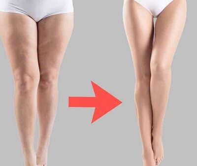 Những lưu ý quan trọng khi giảm mỡ đùi trong